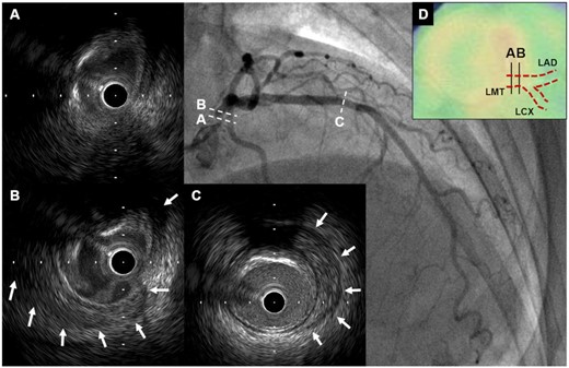 Intravascular ultrasound findings of Case 2. (A and B) Intravascular ultrasound revealed obscured three-layered structure and peri-arterial low-echoic area (white arrows) in left main trunk. (C) Peri-arterial low-echoic area (white arrows) was observed at the site of mild plaque in mid-left anterior descending artery segment. (D) On PET-CT, there was increased F-18 fluorodeoxyglucose uptake in left main trunk where abnormal IVUS findings were seen. CT, computed tomography; IVUS, intravascular ultrasound; LAD, left anterior descending artery; LCX, left circumflex coronary artery; LMT, left main trunk; PET, positron emission tomography.