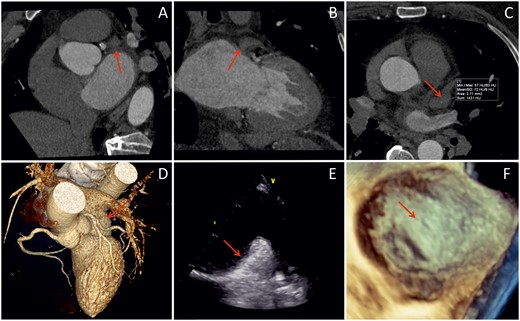 Baseline imaging showing no left atrial appendage (arrows). (A–C) Computed tomography scans, (D) three-dimensional computed tomography rendering, (E) transoesophageal echocardiography, and (F) three-dimensional transoesophageal echocardiography.