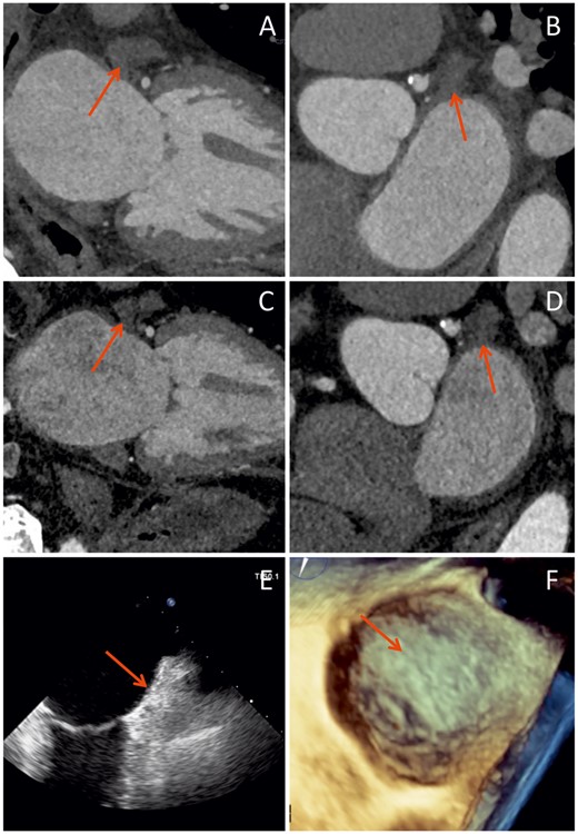 A follow-up imaging showing stationary results. (A and B) Six-month computed tomography scan, (C and D) 12-month computed tomography scan, (E) 12-month transoesophageal echocardiography, and (F) 12-month three-dimensional transoesophageal echocardiography.