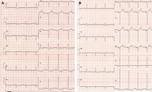 Electrocardiogram before/after cardiac resynchronization therapy implantation. (A) Pre-implantation and (B) post-implantation.