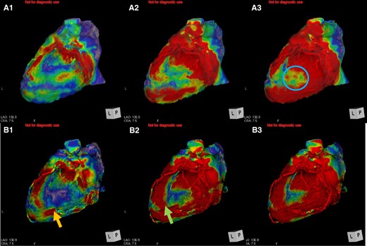 The moving pattern observed by four-dimensional computed tomography. (A) Pre-implantation. The red site gradually shifts over time (A1→A3). The area glowing at the end was in the middle of lateral left ventricular (A3, blue circle). (B) Post-implantation. The red site shifts gradually over time (B1→B3). B1: the left ventricular pacing site moved along with movement pattern of A1 (B1, orange arrow). B2: The more distal area of left ventricular pacing site moved (B2, green arrow).