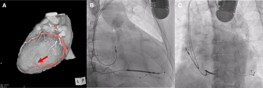 Cardiac resynchronization therapy implantation. (A) The left ventricular lead was implanted at the most delayed site evaluated by four-dimensional computed tomography (red arrow). (B and C) Fluoroscopic view (right anterior oblique 30° and left anterior oblique 45°).