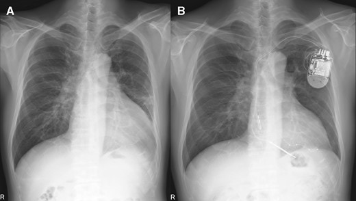 Chest X-ray before/after cardiac resynchronization therapy implantation. (A) pre-implantation and (B) post-implantation.