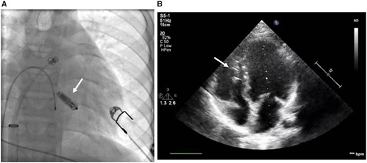 Location of the Micra™ device in fluoroscopy during the implantation procedure (A) and in transthoracic echocardiography (B) in a Patient 1. Location is marked with white arrows.