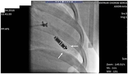 Micra™ implantation procedure in a Patient 2. Two self-expanding nitinol tines are marked with white arrows.
