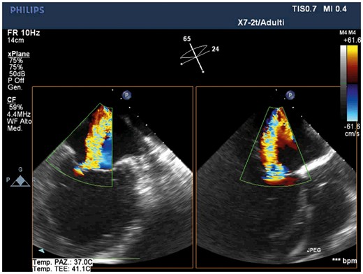 Pre-procedural transoesophageal echocardiography showing severe mitral regurgitation due to tethering of the leaflets resulting in multiple jet, the major between A2 and P3 (intercommissural and outflow tract transoesophageal views). Images show the severely dilated and spherical left ventricle.