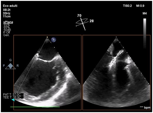 Intraprocedural transoesophageal echocardiography showing active Impella CP during mitral leaflets grasping by XTR MitraClip (intercommissural and outflow tract transoesophageal views).