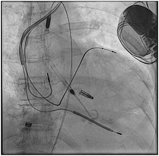 Fluoroscopic image showing the deployed XTR MitraClip and the active Impella CP. No dislocation of cardiac resynchronization defibrillator leads occurred.