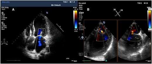 Post-procedural transthoracic echocardiography (A) and transoesophageal echocardiography (B) (intercommissural and outflow tract transoesophageal echocardiography views) showing the optimal result with residual mild mitral regurgitation.