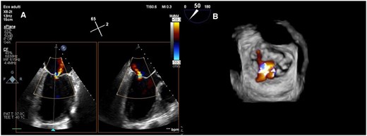 Pre-procedural transoesophageal echocardiography (intercommissural and outflow tract views) showing degenerated leaflets and tethering of posterior mitral leaflets determining severe eccentric mitral regurgitation (A). Three-dimensional surgical visualization showing multiple mitral regurgitation jets between A2-P1 and A2-P3 scallops (B).