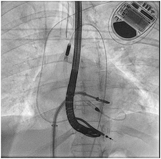 Fluoroscopic guidance during XTR MitraClip deployment with Impella CP active across the aortic valve.