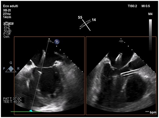Intraprocedural transoesophageal echocardiography showing active Impella CP before mitral leaflets grasping by XTR MitraClip (intercommissural and outflow tract transoesophageal views).