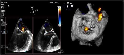 Final transoesophageal echocardiography demonstrating trivial/mild mitral regurgitation after XTR MitraClip delivery and Impella CP removal in intercommissural and outflow tract views (A) and three-dimensional surgical visualization (B).