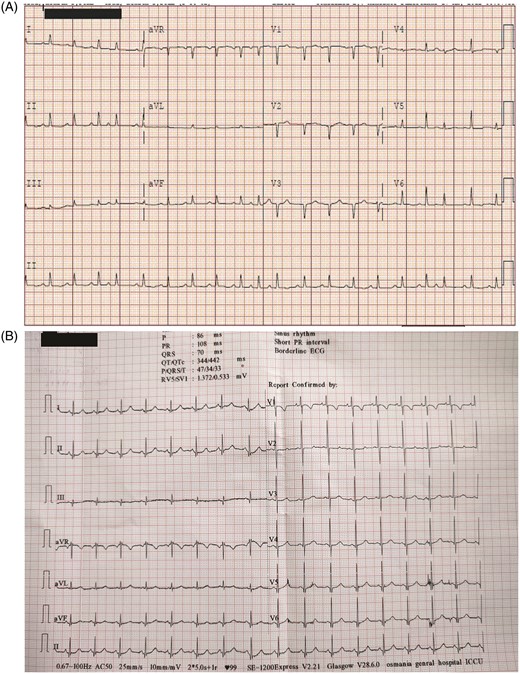 (A) Electrocardiogram showing low voltage complexes and electrical alternans. (B) Electrocardiogram post pericardiocentesis showing normal voltage complexes and resolution of electrical alternans.