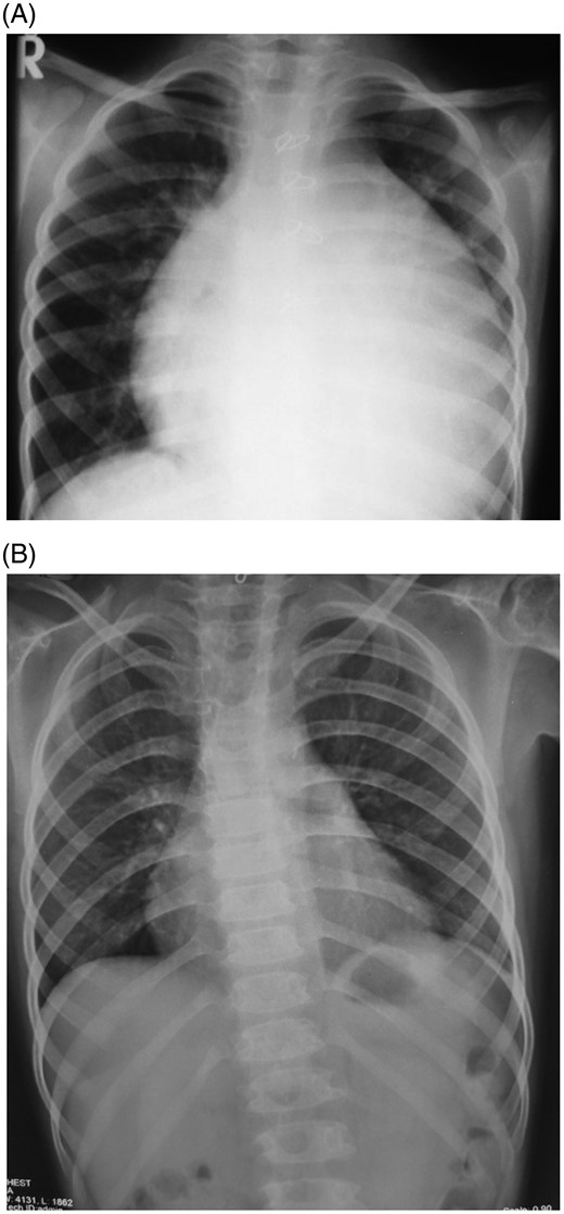 (A) Chest X-ray PA view showing massive cardiomegaly with normal lung fields and typical ‘water bottle’ configuration. (B) Chest X-ray post pericardiocentesis showing resolution of pericardial effusion.