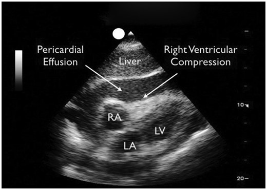 2D echocardiography sub costal view showing massive pericardial effusion and right ventricular diastolic collapse.