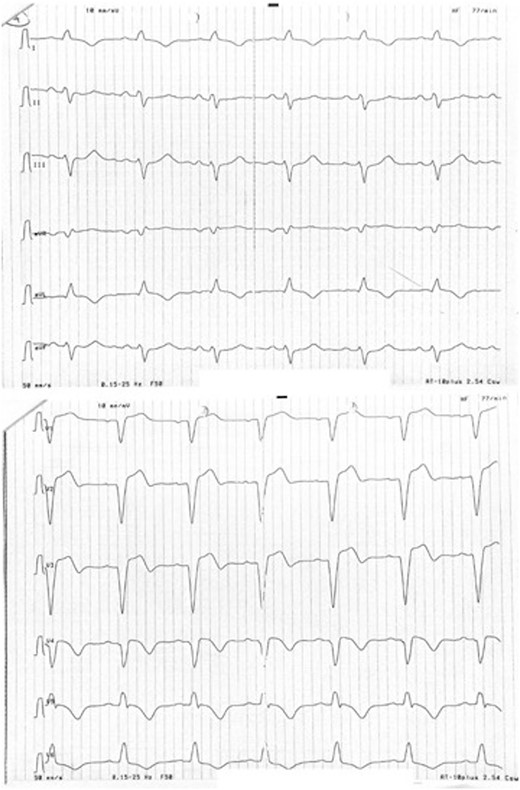 Sinus rhythm with pre-existing left bundle branch block. There were no electrocardiographic differences before and after percutaneous coronary intervention. Some remaining ST-T elevation could be an indicator of ischaemia in the setting of left bundle branch block.