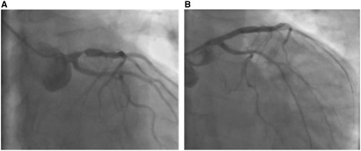 Coronary angiography and percutaneous coronary intervention. Coronary angiography revealed a subtotal stenosis of the proximal left anterior descending artery (A), which was treated by implantation of a single drug-eluting stent (B).