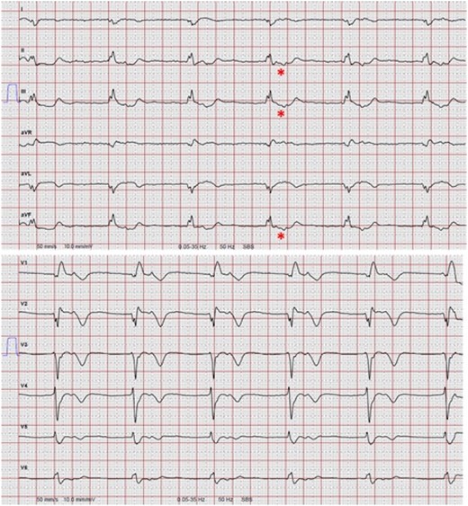 Accelerated idioventricular rhythm with right bundle branch block morphology. The electrocardiogram was recorded 10 days post-intervention at admission for cardiac rehabilitation. No P-waves precede the QRS, but the QRS appears to be followed by retrograde P-waves detectible during the ST-segment. Retrograde P-waves exhibit a vector negative in leads II, III, and aVF (*). Thus, the most likely diagnosis is an accelerated idioventricular rhythm. The wide QRS shows right bundle branch morphology.
