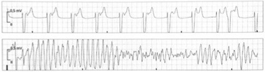 Onset of Torsade de Pointes tachycardia/ventricular fibrillation. Again, there are retrograde P-waves visible during the ST-segment confirming accelerated idioventricular rhythm. Following a short–long–short sequence, R-on-T-phenomenon initiates malignant ventricular arrhythmia compatible with Torsade de Pointes tachycardia degenerating into ventricular fibrillation.