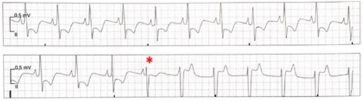 Shift from sinus rhythm with left bundle branch block to accelerated idioventricular rhythm with right bundle branch block seconds before onset of Torsade de Pointes tachycardia/ventricular fibrillation. The fourth QRS in the second row is probably a fusion complex (*). Note that in contrast to P-wave morphology in accelerated idioventricular rhythm, P-waves during sinus rhythm exhibit an inferior axis.