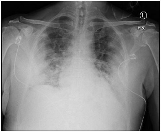 Chest radiograph with bilateral pulmonary infiltrates.