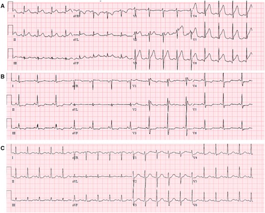 (A) ECG on day 1 shows diffuse ST elevation and PR depression in precordial and limb leads, reciprocal ST depression, and PR elevation in aVR. (B) Day 6 shows incomplete right bundle branch block and horizontal ST depression in precordial and limb leads. (C) Day 13 shows sinus tachycardia without ST or T wave abnormalities.