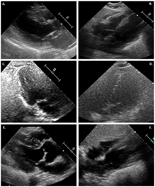 (A) TTE in parasternal long-axis view at end systole, demonstrating severe LV systolic dysfunction. (B) Subcostal view with small pericardial effusion. (C) Repeat echocardiogram on day 6 in three-chamber view at end systole, demonstrating normal LV function. (D) Resolution of pericardial effusion on hospital day 6. (E) TTE at day 35, showing continued normal systolic function in the parasternal long-axis view at end systole. (F) No further pericardial effusion on subcostal view.