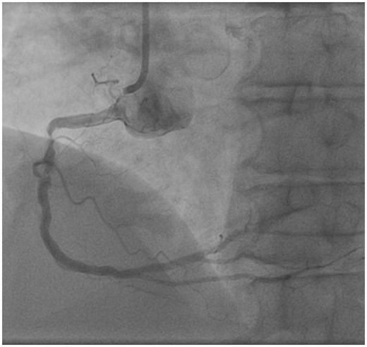 Heavily calcified stenosis in the right coronary artery.