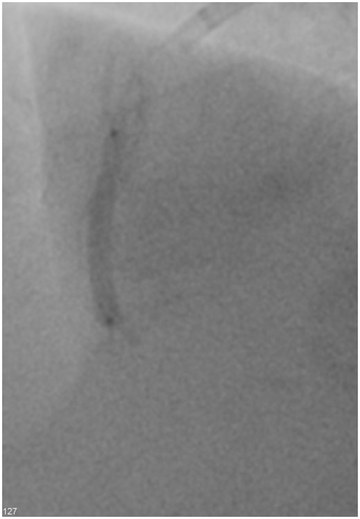 Non-compliant balloon post-rotational atherectomy and pre-intravascular lithotripsy.