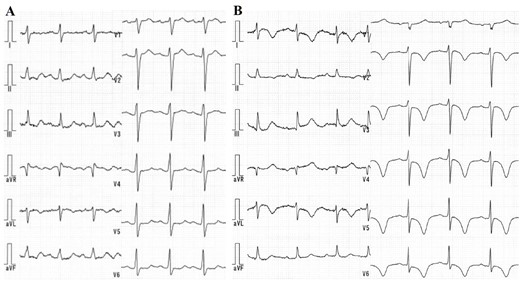 (A) The electrocardiogram on arrival showing a sinus rhythm and no remarkable ST-T change. (B) T-wave inversion in the broad range of the limb and chest leads on Day 2 of hospitalization.
