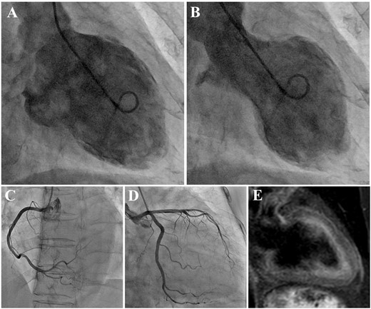 (A) Left ventriculography in diastolic phase. (B) Left ventriculography in systolic phase demonstrating the typical findings of apical ballooning and a hyperkinetic wall motion at the basal level of the left ventricle. The coronary angiogram showing intact coronary arteries. Right coronary artery (C). Left coronary artery from right anterior oblique caudal view (D). (E) A short tau inversion recovery image of cardiovascular magnetic resonance imaging showing high intensity at the area of regional wall motion abnormality.