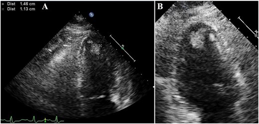 (A) Ultrasound cardiography showing mural thrombus formation (1.46 × 1.13 cm) in the left ventricular apex on Day 5 of hospitalization. (B) Magnified image of the apex.