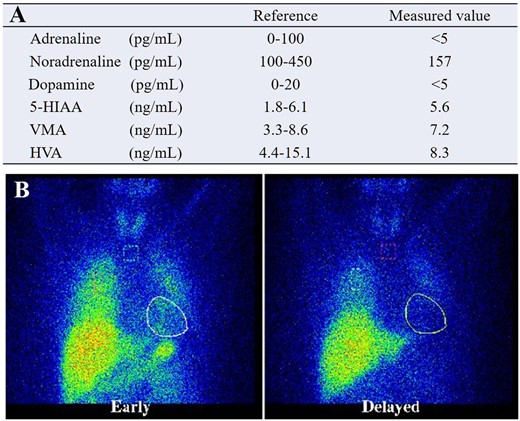 (A) Blood chemical concentrations of each kind of catecholamine, all within normal limits. (B) 123I-metaiodobenzylguanidine scintigraphy suggesting a decreased sympathetic function.