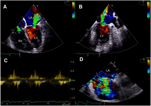 Colour Doppler images of preprocedural transoesophageal echocardiography showing severe mitral regurgitation in four-chamber (A) and two-chamber view (B) with systolic reversal of pulmonary vein flow (C). Furthermore, significance of left-to-right shunt via an atrial septal defect is displayed (D). LA, left atrium; LV, left ventricle; RA, right atrium; RV, right ventricle.