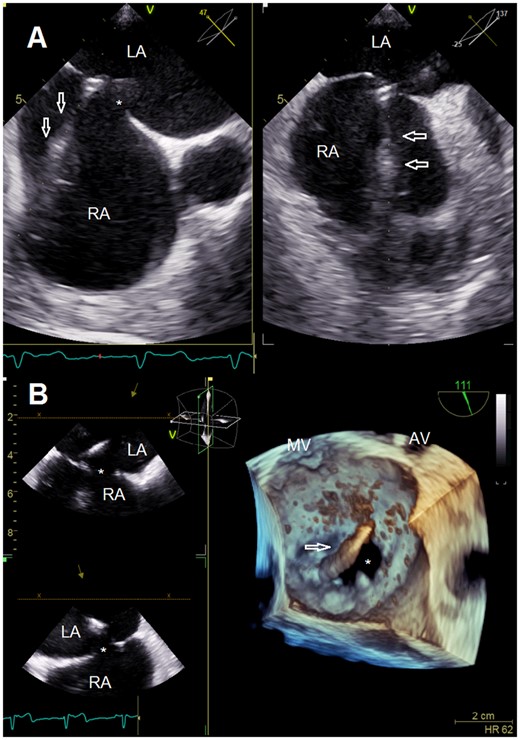 Transseptal puncture guided by multi-plane transesophageal echocardiography (A). Clip delivery system introduced into the left atrium via a separate transseptal puncture posterior to the immanent atrial septal defect (B). AV, aortic valve; LA, left atrium; MV, mitral valve; RA, right atrium; *, atrial septal defect; arrowheads, transseptal puncture stiletto (A) and clip delivery system (B).