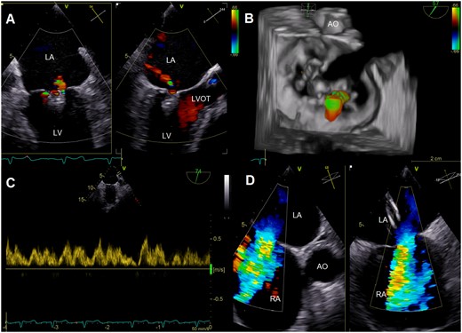 Multi-plane colour Doppler images (A) and three-dimensional reconstruction with colour Doppler (B) after deployment of two MitraClips showing significant reduction of mitral regurgitation. Systolic pulmonary vein flow reversal was eliminated (C), while colour Doppler images illustrated persistence of significant left-to-right shunt via the atrial septal defect (D). AO, aorta; LA, left atrium; LV, left ventricle; LVOT, left ventricular outflow tract; RA, right atrium.