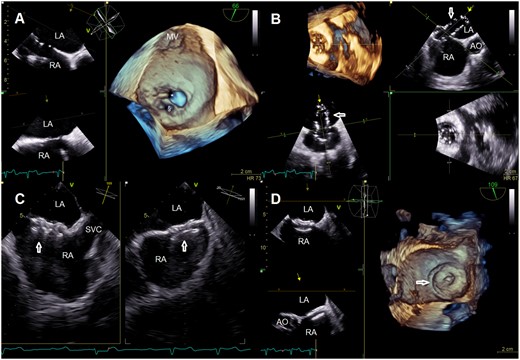 Multi-plane view with three-dimensional reconstruction showing the pre-existing and the artificial atrial septal defect (A), its sizing with balloon (B) and after deployment of an Amplatzer occluder (C, D). AO, aorta; LA, left atrium; MV, mitral valve; RA, right atrium; SVC, superior vena cava; *, atrial septal defect; §, artificial atrial septal defect; arrowheads, sizing ballon (B) and Amplatzer occluder (C, D).