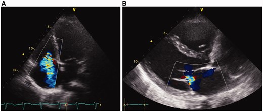 Echocardiography at admission to the University hospitals’ emergency department demonstrating severe biventricular cardiac failure with dilated right and left ventricle with large tricuspid regurgitation (A) and paradoxical movement of the interventricular septum in systole and moderate mitral regurgitation (B).
