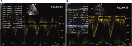 Stroke volume at the first day (A) and second day (B) on extra corporal membrane oxygenation treatment. Additional treatment with levosimendan and iodine solution was given.