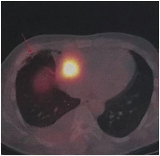 Somatostatin receptor imaging reveals abnormalities in the right atrioventricular sulcus.