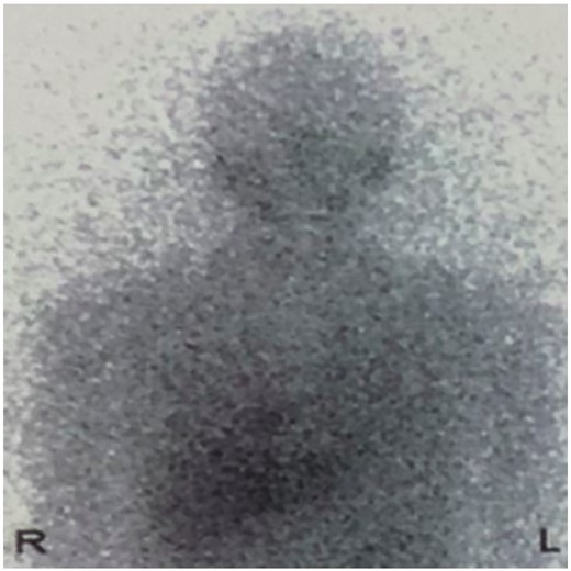 Iodine-131 metaiodobenzylguanidine shows radiotracer accumulation in the right upper chest.