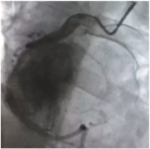 Angiography of the right coronary artery shows the mass.
