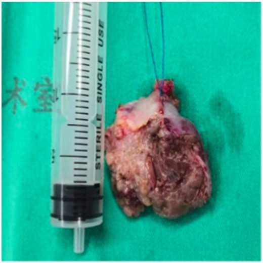Gross pathological image of the resected mass (3 cm × 4 cm).