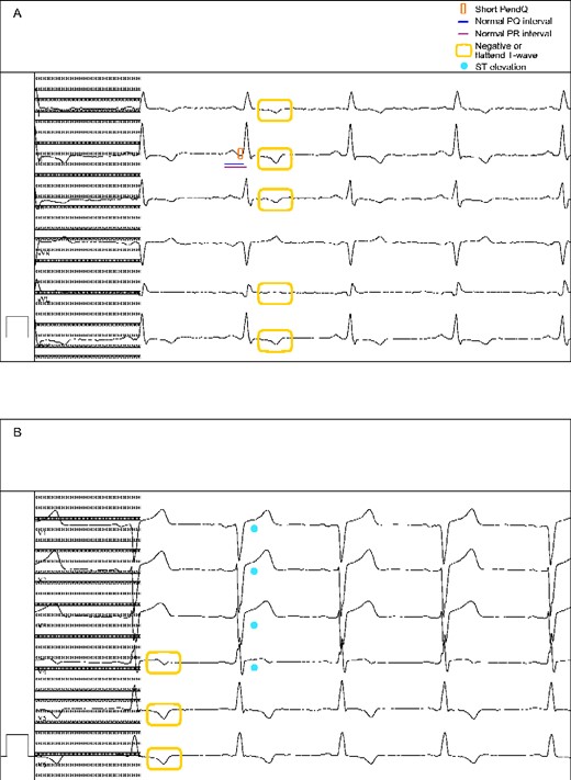 Electrocardiogram (2020) presenting (A) a short PendQ interval (red box), a normal PQ (blue line) and PR interval (purple line), (A, B) negative or flattened T waves (yellow box) as well as (B) ST elevations (light blue point). 50 mm/s, 10 mm/mV.
