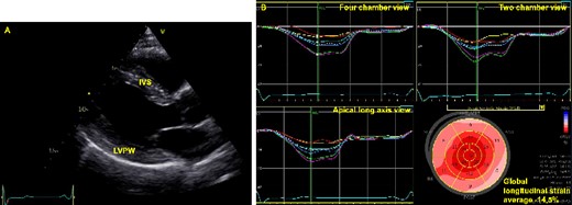 (A) Echocardiographic imaging of the left ventricle in parasternal long axis view showing thickened left ventricular wall. IVS, interventricular septum (15 mm); LVPW, left ventricular posterior wall (15 mm). (B) Left ventricular global longitudinal strain visualized with automated function imaging. Notice the reduced global longitudinal strain and the impaired contractility posterior and lateral.