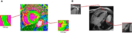 Cardiovascular magnetic resonance T1 mapping (3 T MR) visualized short T1 time (1085 ms), indicative of sphingolipid storage (A). The same image displays areas of prolonged T1 time (1310 ms, A), which correlates with late gadolinium enhancement as a surrogate for fibrosis in Fabry disease (B).