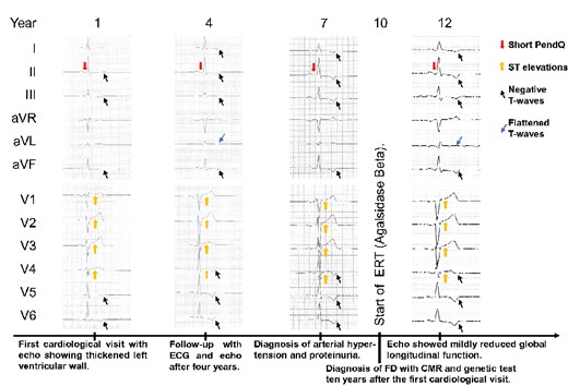 Timeline with typical ECG findings for FD, especially the short PendQ interval, i.e. PQ minus P-wave, and changes of the ST segments and T-waves (2008–2020). 50 mm/s, 10 mm/mV. ECG, electrocardiogram; FD, Fabry disease; CMR, cardiac magnetic resonance imaging; ERT, enzyme replacement therapy.