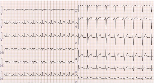 Electrocardiogram on admission showing an abnormal Q wave and an inverted T wave in lead aVL, with a flattened T wave in a lead I.