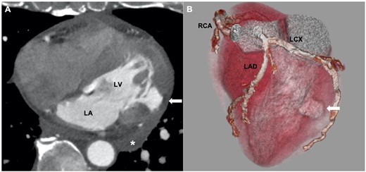 (A) Cardiac computed tomography showing mild pericardial effusion (*), and an aneurysmal cavity at the inferolateral wall of left ventricle (LV) with a thin wall and a narrow neck (white arrow). (B) Three-dimensional reconstruction image showed that the aneurysm corresponded to the perfusion territory of first obtuse marginal branch (white arrow). LA, left atrium; LAD, left anterior descending artery; LCX, left circumflex artery; RCA, right coronary artery.